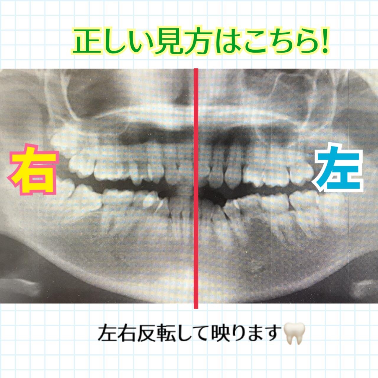 レントゲン